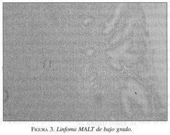 Linfoma MALT de bajo grado Linfoma MALT de bajo grado