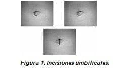 Incisiones Umbilicales. Incisiones Umbilicales.