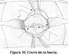 Cierre de la Fascia Cierre de la Fascia