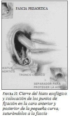 Fascia Preaortica Fascia Preaortica