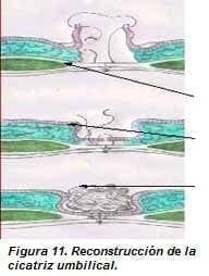 Reconstrucción de la Cicatriz Umbilical Reconstrucción de la Cicatriz Umbilical