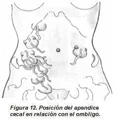 Posición del Apendice Cecal en relación con el Ombligo