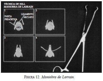 Maniobra de Larrain Maniobra de Larrain