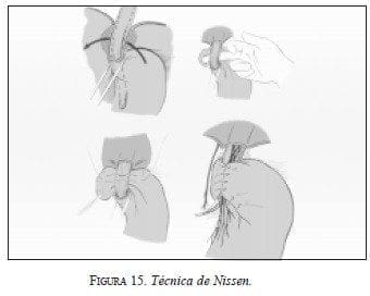 Técnica de Nissen Técnica de Nissen