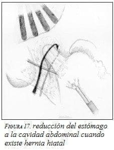 Reducción del Estómago a la cavidad Abdominal Reducción del Estómago a la cavidad Abdominal