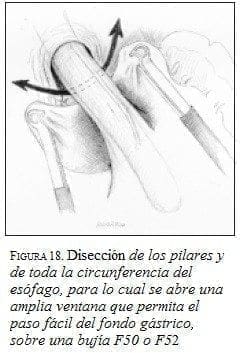 Disección de los pilares y de toda la circunferencia del esófago, Disección de los pilares y de toda la circunferencia del esófago