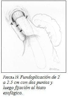 Fundoplicación Fundoplicación