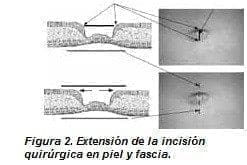 Extensión de la Incisión Quirúrgica en Piel y Fascia Extensión de la Incisión Quirúrgica en Piel y Fascia