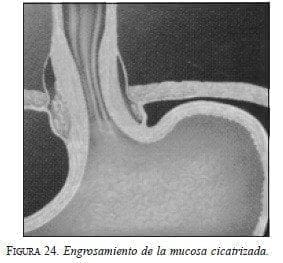 Engrosamiento de la Mucosa Cicatrizada Engrosamiento de la Mucosa Cicatrizada