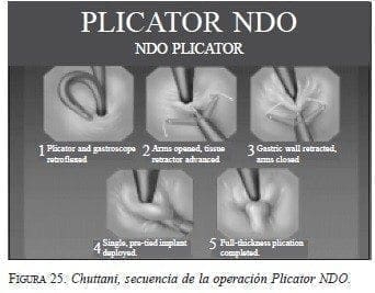 Chuttani, secuencia de la operación Plicator NDO Chuttani, secuencia de la operación Plicator NDO
