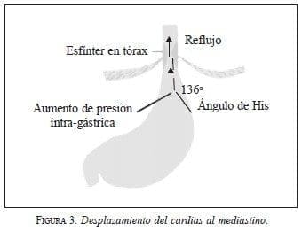 Desplazamiento del Cardias al Mediastino Desplazamiento del Cardias al Mediastino