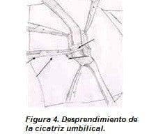 Desprendimiento de la Cicatriz Umbilical Desprendimiento de la Cicatriz Umbilical