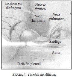 Técnica de Allison Técnica de Allison