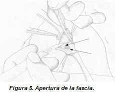 Apertura de la Fascia Apertura de la Fascia