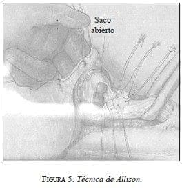 Técnica de Allison, Saco abierto Técnica de Allison, Saco abierto
