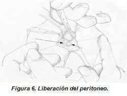 Liberación del Peritoneo Liberación del Peritoneo