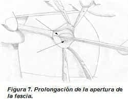 Prolongación de la Apertura de la Fascia Prolongación de la Apertura de la Fascia
