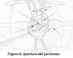 Apertura del Peritoneo Apertura del Peritoneo
