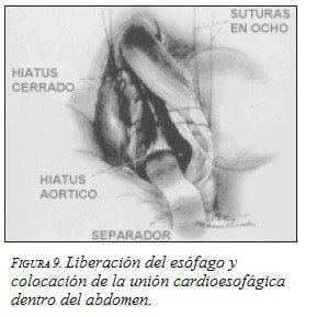 Liberación del Esófago Liberación del Esófago