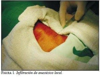 Infiltración de Anestésico Local