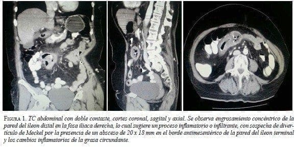TC Abdominal con doble Contaste, cortes coronal, sagital y axial