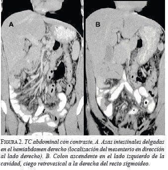 TC Abdominal con contraste