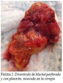 Divertículo de Meckel perforado y con plastrón