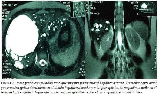 Tomografía Computadorizada que muestra Poliquistosis Hepática Asilada Tomografía Computadorizada que muestra Poliquistosis Hepática Asilada