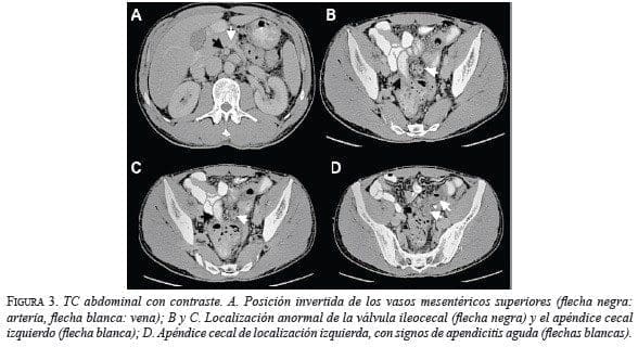 TC Abdominal con contraste TC Abdominal con contraste