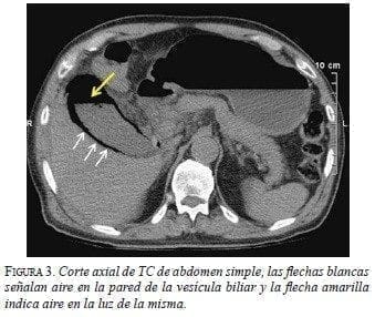 Corte axial de TC de abdomen simple
