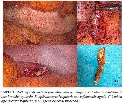 Hallazgos durante el Procedimiento Quirúrgico Hallazgos durante el Procedimiento Quirúrgico