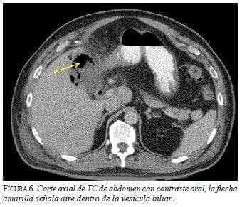 Corte Axial de TC de Abdomen con Contraste Oral