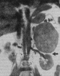 Tumor adrenal izquierdo Tumor adrenal izquierdo