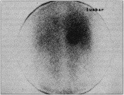 Escintigrafía con metayodobenzilguanidina Escintigrafía con metayodobenzilguanidina