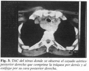 TAC del torax