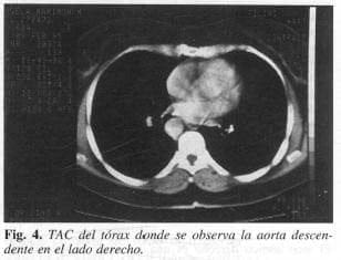 TAC del torax