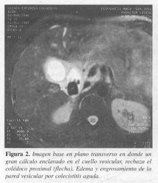 Cálculo Enclavado en el Cuello Vesicular Cálculo Enclavado en el Cuello Vesicular