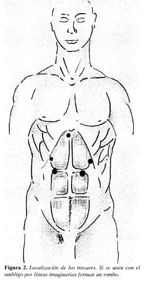 Localización de los Trocares Localización de los Trocares