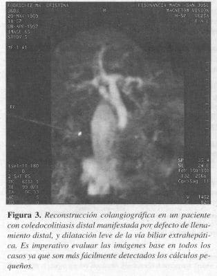 Llenamiento Distal, y Dilatación Leve de la Vía Biliar Extrahepática Llenamiento Distal, y Dilatación Leve de la Vía Biliar Extrahepática