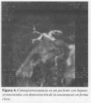 Paciente con Hepatoyeyunostomía con Demostración de la Anastomosis Paciente con Hepatoyeyunostomía con Demostración de la Anastomosis