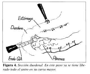Sección Duodenal Sección Duodenal