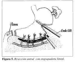 Resección Antral con Engrapadora Lineal Resección Antral con Engrapadora Lineal