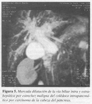 Vía Biliar Intra y Extrahepática Vía Biliar Intra y Extrahepática