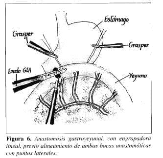 Anastomosis Gastroyeyunal, con Engrapadora Lineal Anastomosis Gastroyeyunal, con Engrapadora Lineal