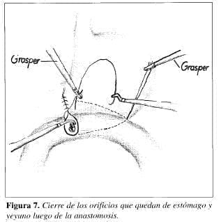 Estómago y Yeyuno luego de la Anastomosis