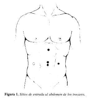 Colocación del rollo en la espalda, y posición de los trocares. Colocación del rollo en la espalda, y posición de los trocares