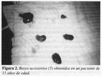 Bazos Accesorios (5) Obtenidos en un paciente de 13 años de edad Bazos Accesorios (5) Obtenidos en un paciente de 13 años de edad