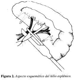 Aspecto esquemático del Hilio Esplénico