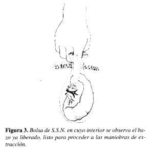 Esplenectomía Laparoscópica en Niños, Bolsa de S.S.N