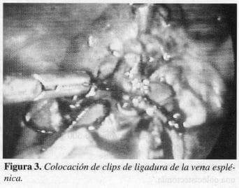 Colocación de clips de ligadura de la Vena Esplénica Colocación de clips de ligadura de la Vena Esplénica